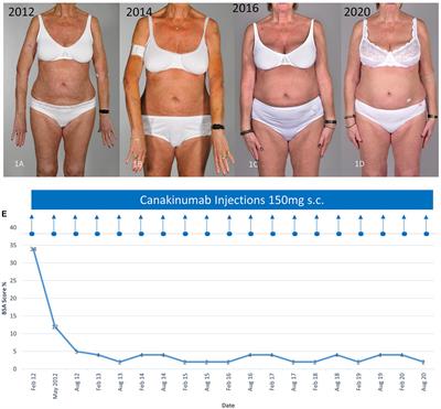 Canakinumab leads to rapid reduction of neutrophilic inflammation and long-lasting response in Schnitzler syndrome